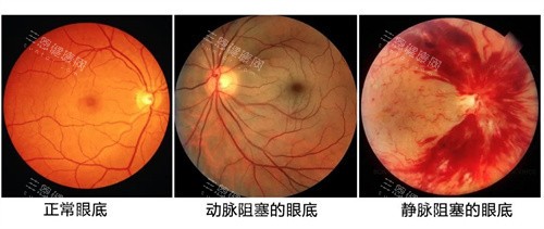眼底检查的重要性 眼底检查的重要性