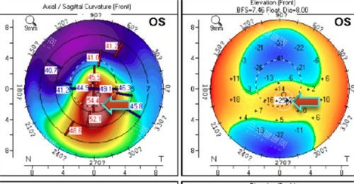 眼底检查图 眼底检查图