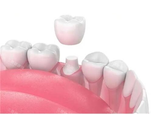 牙齿戴牙冠示意图 牙齿戴牙冠示意图