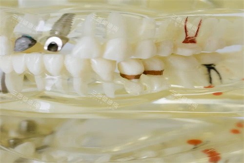 假牙材料宣传 假牙材料宣传