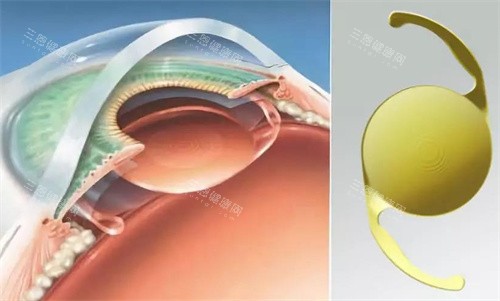 白内障人工晶体的选择 白内障人工晶体的选择