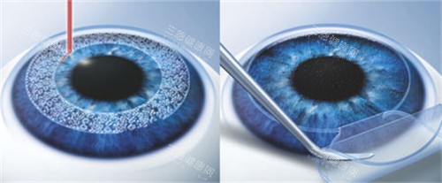 全飞秒手术图示 全飞秒手术图示