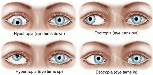 不同眼睛斜视和正常眼睛的对比