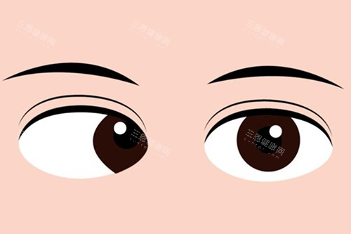 斜视眼睛卡通图展示照片