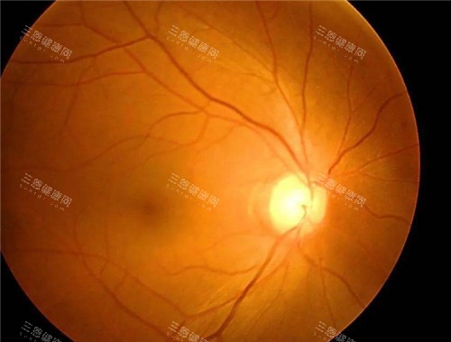 青光眼视力表现图