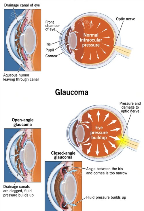 青光眼和正常眼睛眼压不同