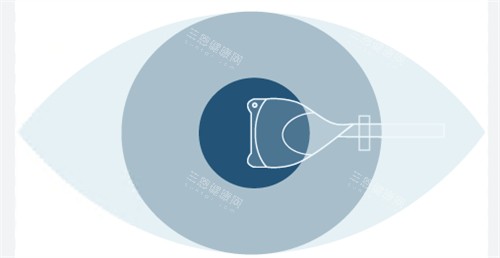 人工晶体植入手术图示 人工晶体植入手术图示