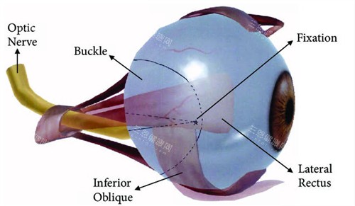 后巩膜加固术动画图 后巩膜加固术动画图