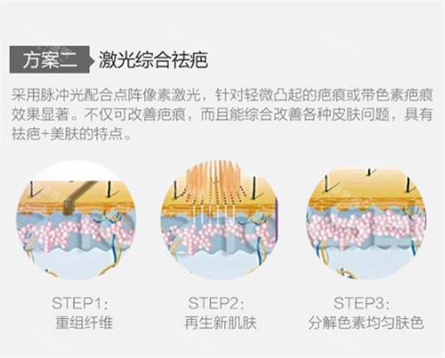 激光祛疤图示 激光祛疤图示