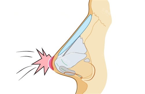 隆鼻假体鼻背动画展示图 隆鼻假体鼻背动画展示图