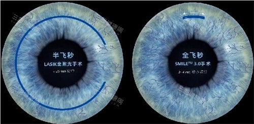 半飞和全飞创口区别 半飞和全飞创口区别