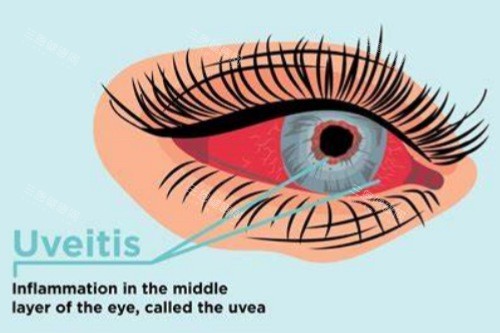 葡萄膜炎 (5) 葡萄膜炎 (5)