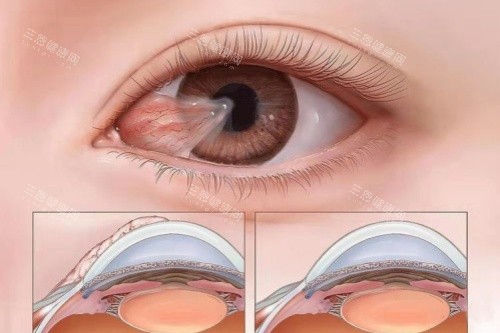 翼状胬肉图片展示 翼状胬肉图片展示