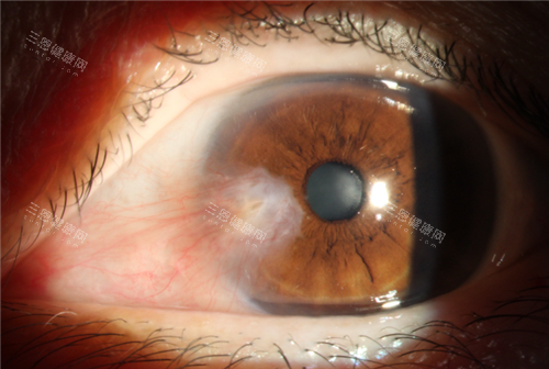 眼角胬肉表现照片 眼角胬肉表现照片