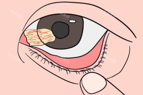 眼角胬肉 眼角胬肉