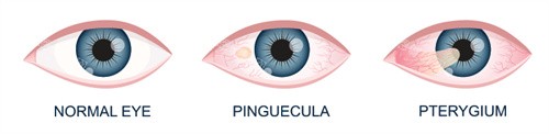 不同程度的眼部翼状胬肉 不同程度的眼部翼状胬肉