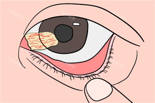 翼状胬肉2 翼状胬肉2