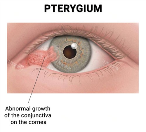 翼状胬肉对眼睛的影响 翼状胬肉对眼睛的影响