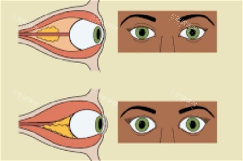 近视眼球对比图 近视眼球对比图