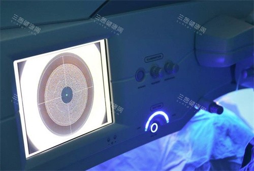 近视眼手术 近视眼手术