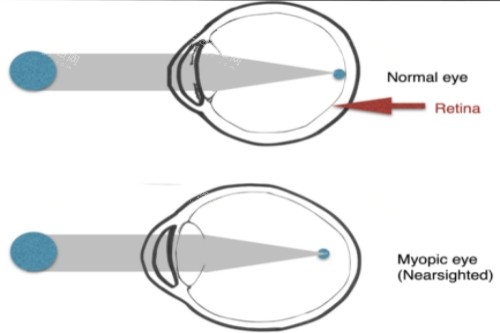正常眼与近视眼对比 正常眼与近视眼对比