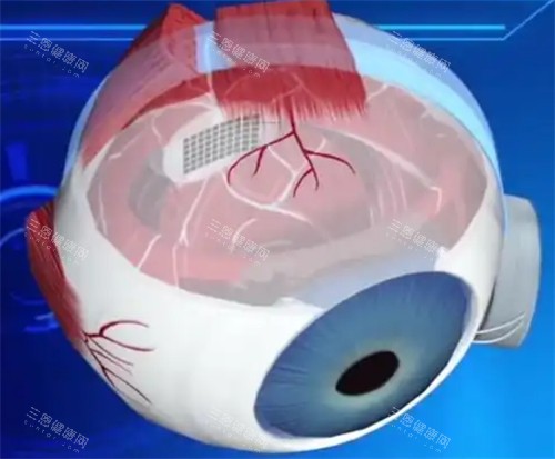 仿生眼球剖析 仿生眼球剖析