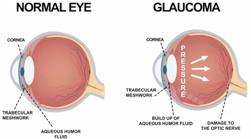 青光眼和正常眼睛对比 青光眼和正常眼睛对比
