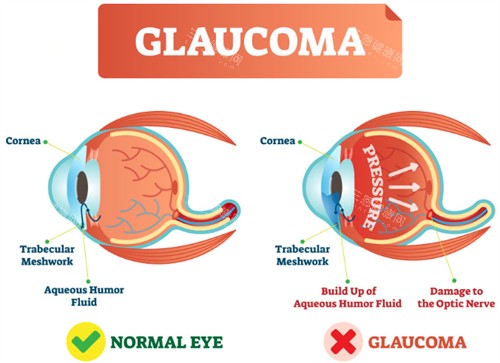 正常眼睛和青光眼的对比 正常眼睛和青光眼的对比