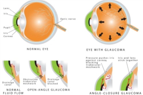 青光眼结构图 青光眼结构图