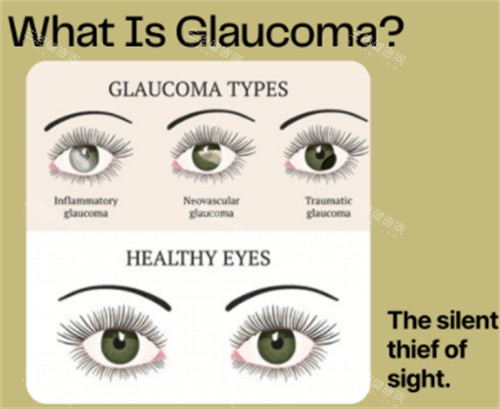 什么是青光眼 什么是青光眼