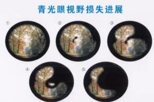 青光眼视野损失进展展示图 青光眼视野损失进展展示图