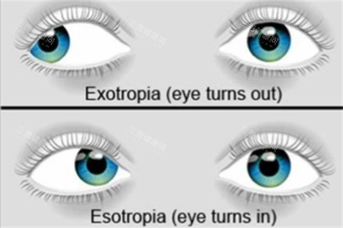 内外斜视 内外斜视