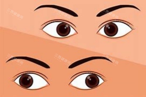 内斜视对比外斜视 内斜视对比外斜视