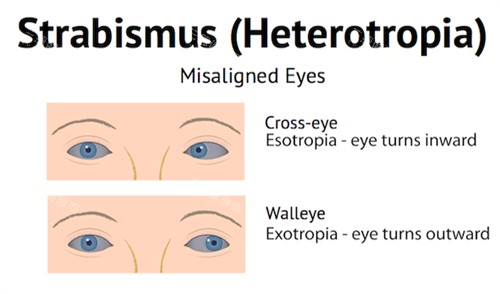 正常眼睛和斜视眼睛对比 正常眼睛和斜视眼睛对比