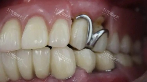 无挂钩假牙展示示意图