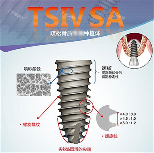 奥齿泰种植牙表面优势