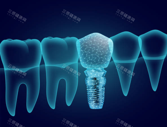 种植牙模型图卡通图