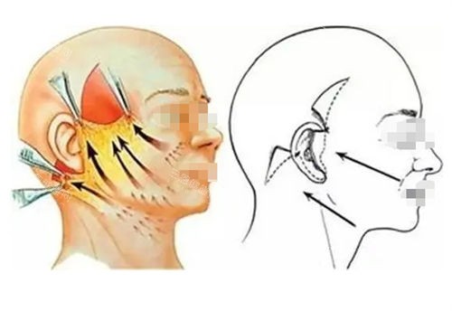 拉皮手术前后提拉对比图