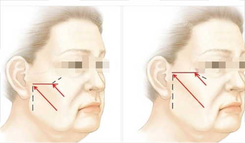 中上面部拉皮提拉方向画线图