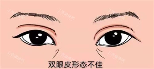 双眼皮修复示图