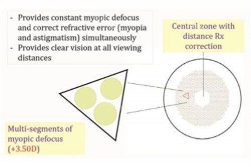 离焦镜片原理图 离焦镜片原理图