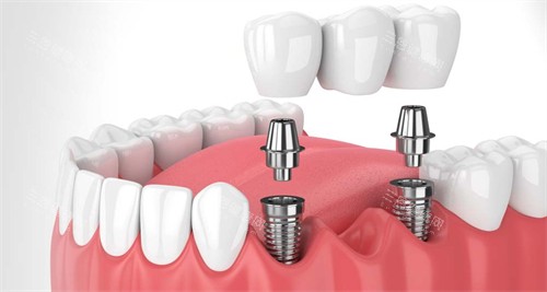 在口腔内进行种植牙 在口腔内进行种植牙