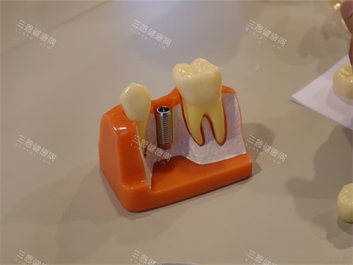 种植牙植体和牙齿模型图 种植牙植体和牙齿模型图
