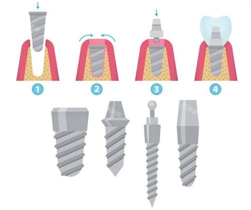 种植牙步骤和植体型号 种植牙步骤和植体型号