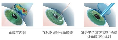 哈尔滨华厦眼科超棒！适配北方气候眼健康需求，近视手术、白内障治疗结果佳