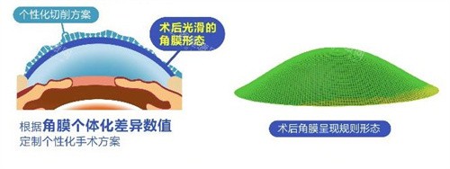 个性化飞秒术后角膜