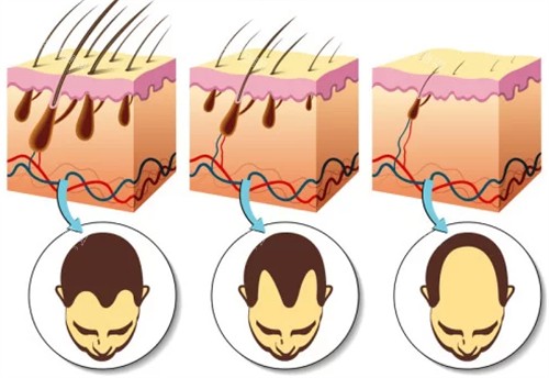 重庆好美厚森植发介绍超实用！专注植发领域，毛囊存活率高，种植自然，术后养护完善