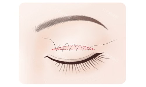 黑龙江瑞丽整形双眼皮医生选这四位！宋桂霞/杨永胜/高峰/韦燕医师，手法精细结果自然