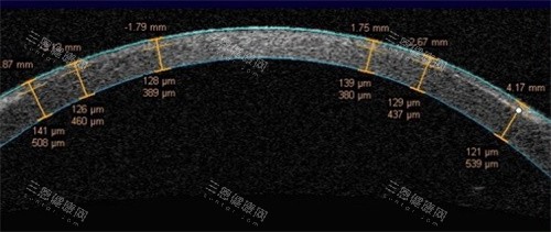 飞秒激光角膜瓣厚度