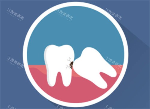 牙齿拥挤示意图